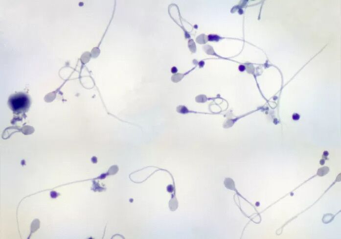 She was diagnosed with oligozoospermia – few sperm